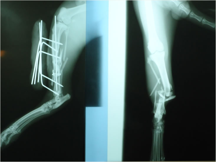 Fracture of tibia